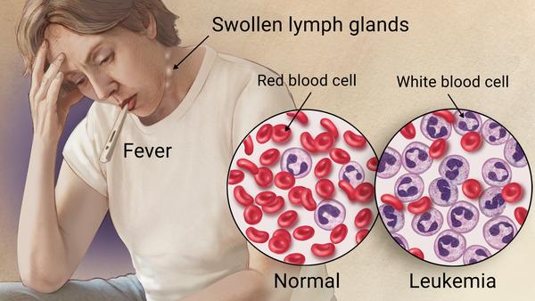 Leukemia (Blood Cancer)